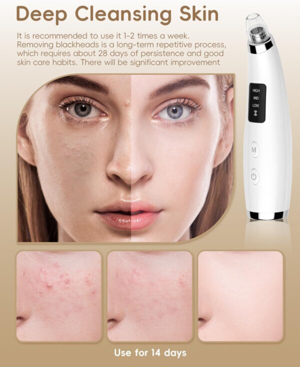 Limited Time Deal 63%OFF! Facial Pore Blackhead Remover Vacuum - Face Cleaner - Image 5