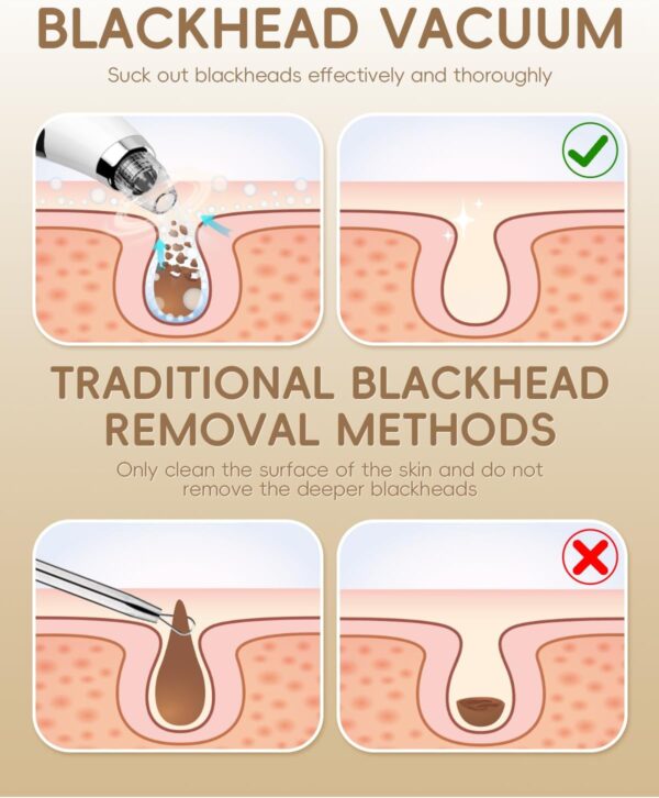 Limited Time Deal 63%OFF! Facial Pore Blackhead Remover Vacuum - Face Cleaner - Image 6