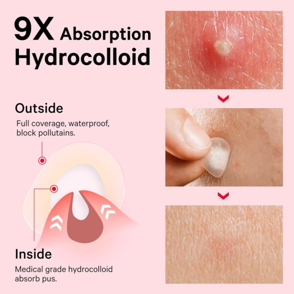 Limited Time Deal 44%OFF! Sosky Pimple Patches for Face - Image 4