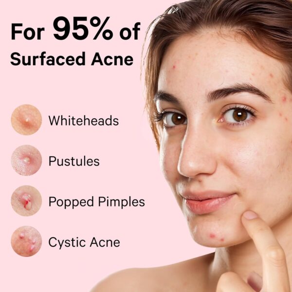Limited Time Deal 44%OFF! Sosky Pimple Patches for Face - Image 8
